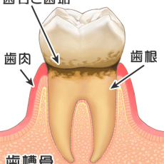 歯周病治療